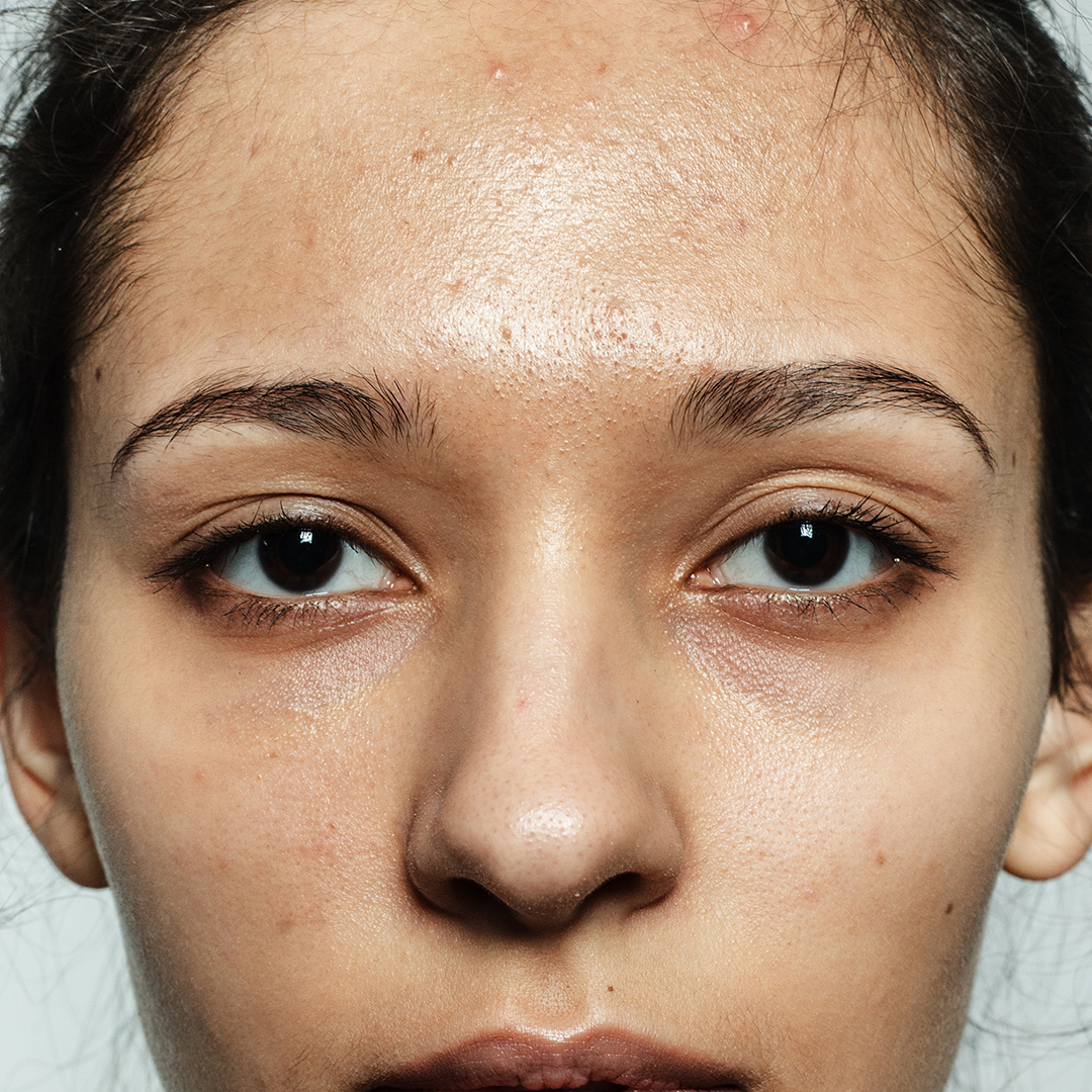 Excess oil secretion