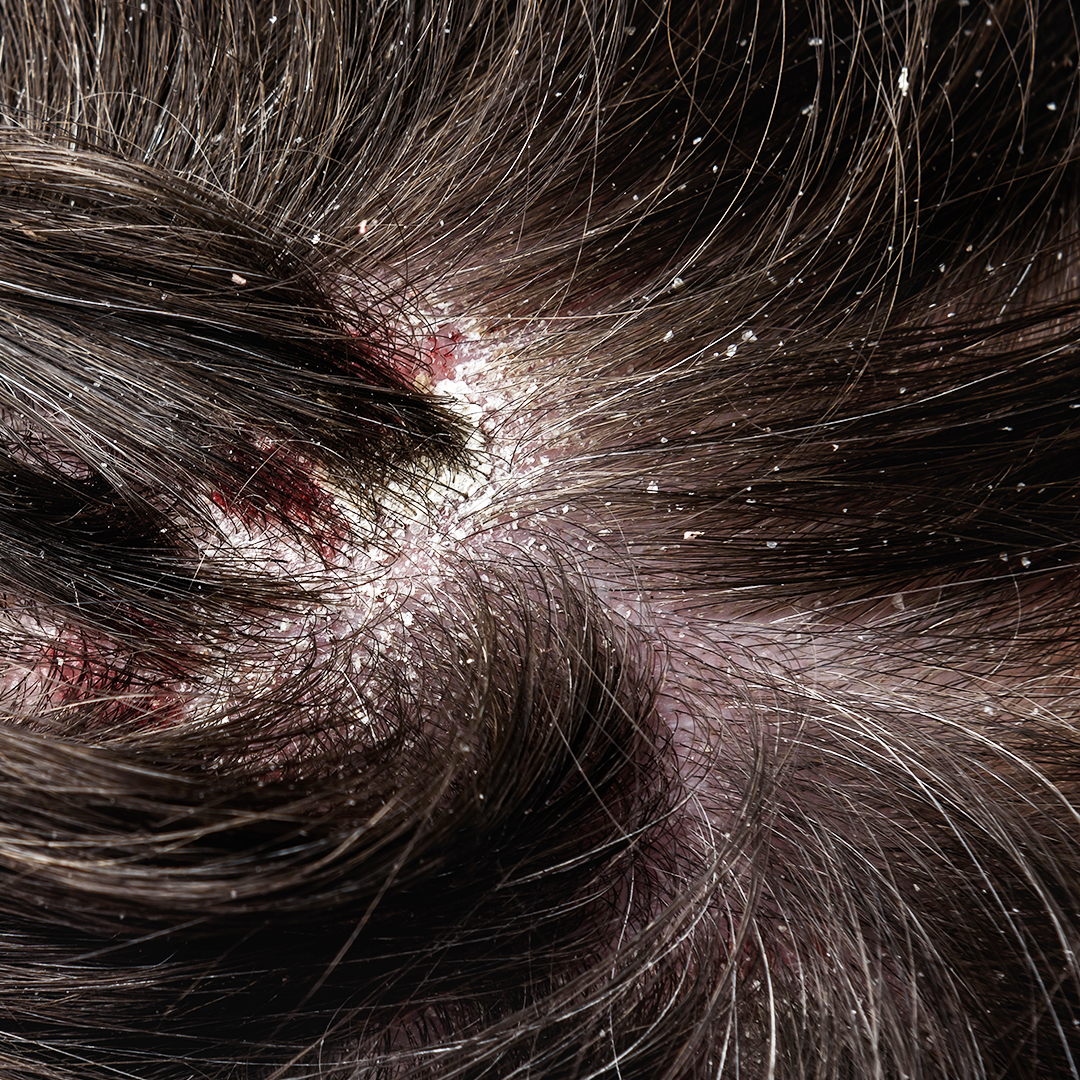 Dry dandruff
