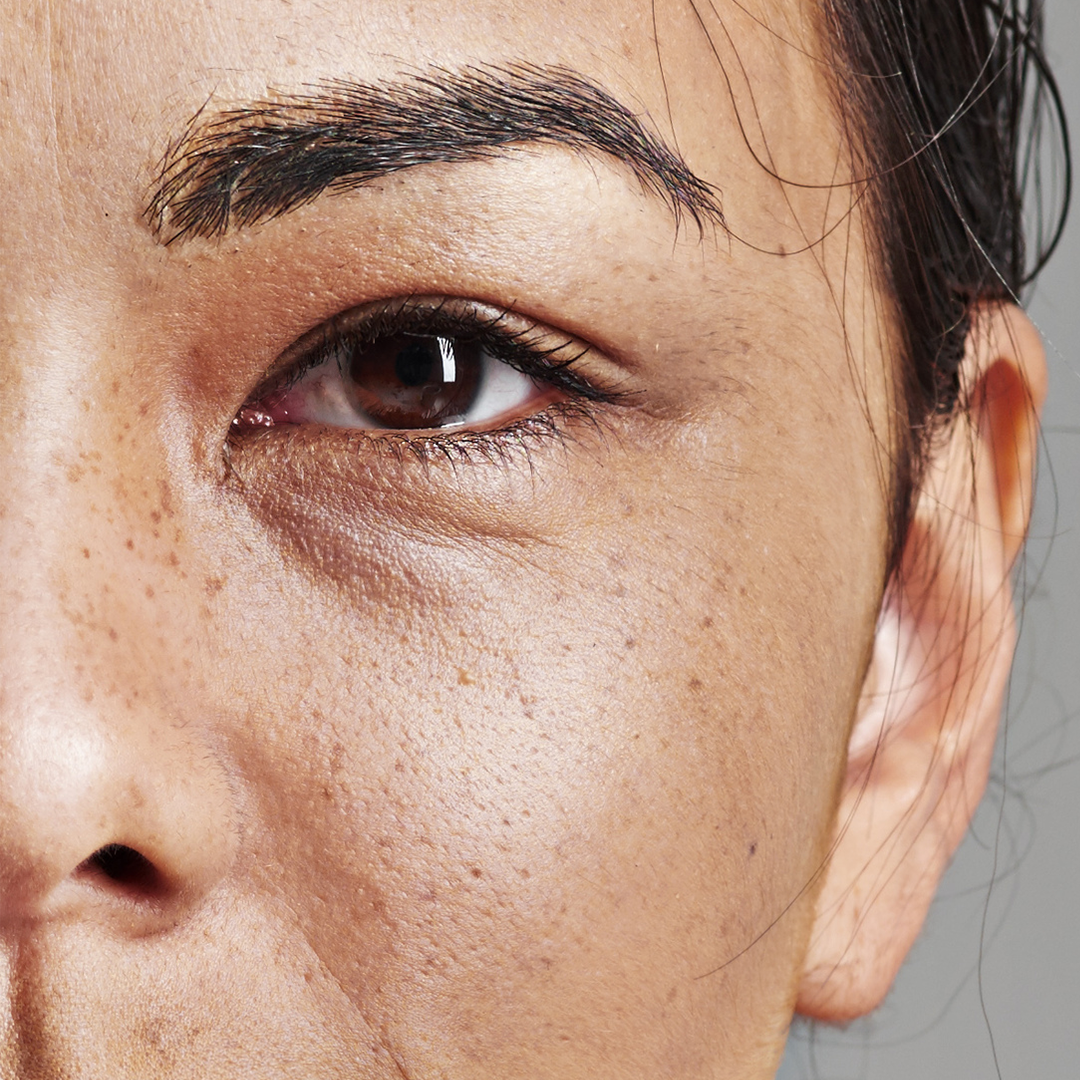 Dull and damage skin