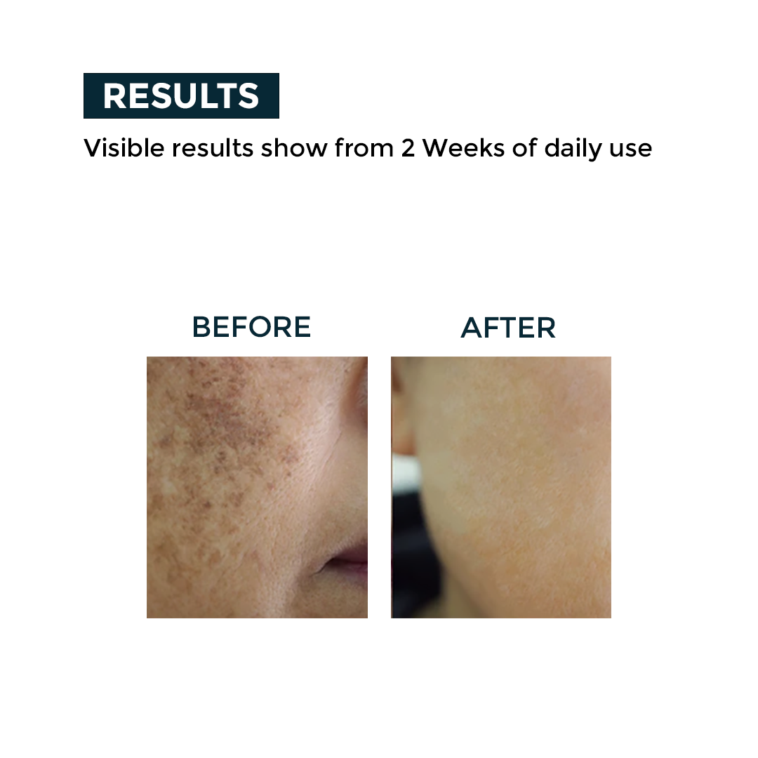 Nerbon Depigmentation Serum