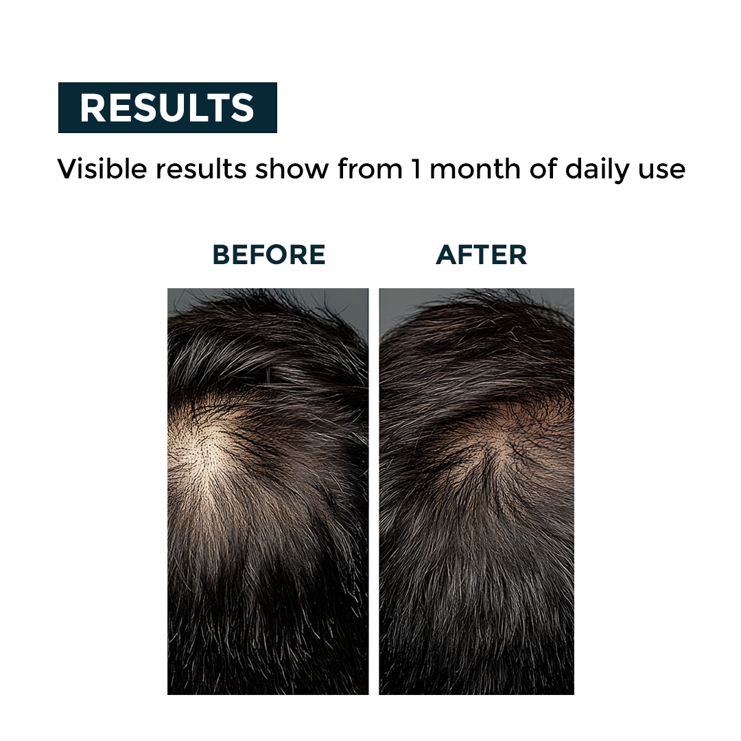 Nerbon Hair Fall & Dandruff Control Shampoo