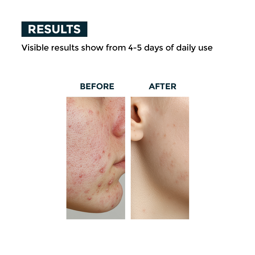 Nerbon Neem & Tulsi Face Wash – Herbal Acne Control